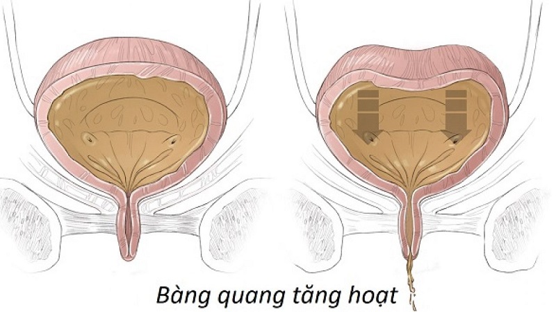 Bàng quang tăng hoạt là khi có cảm giác buồn tiểu gấp khi chưa có nhiều nước tiểu trong bàng quang